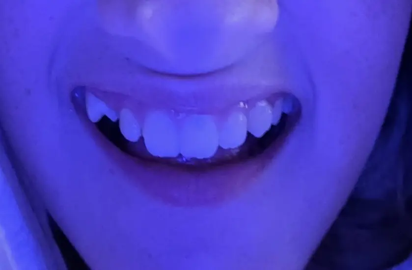 I just realized this is my first post of the day wow but I forgot to that I got my braces! My teeth hurt so much and my family is out of freaking pain killers so I’m lowkey cooked rn but it’s ok I’m going to sleep soo…